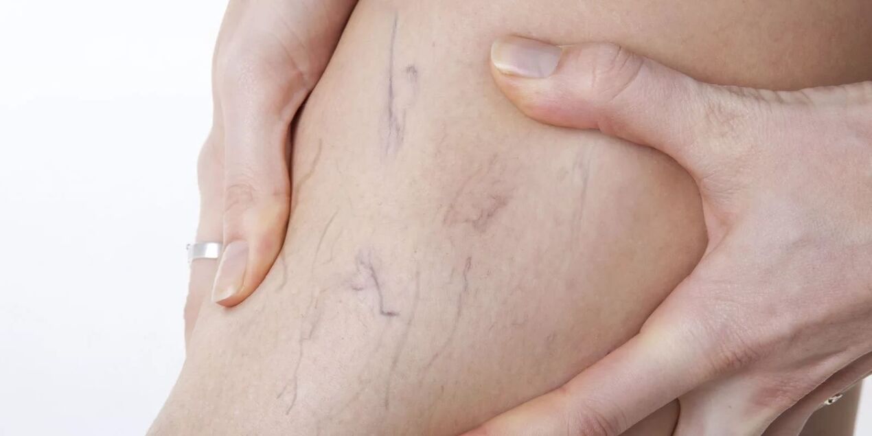 Înainte de utilizarea cremei variconice